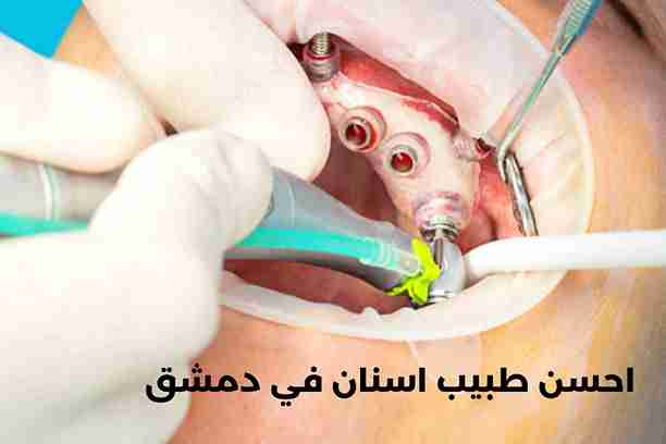 كم تكلفة خدمات احسن طبيب اسنان في دمشق؟