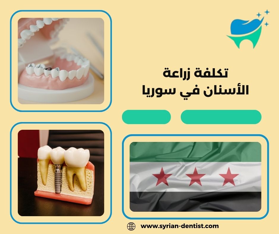 ما هي زراعة الأسنان؟