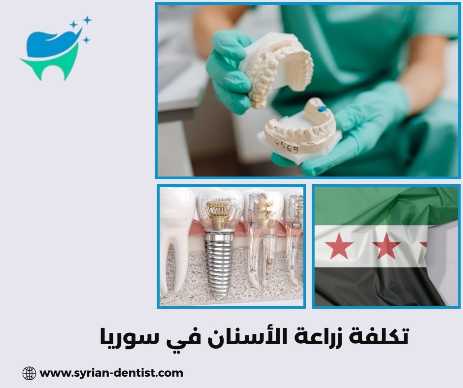 ما العوامل التي تؤثر على تكلفة زراعة الأسنان؟