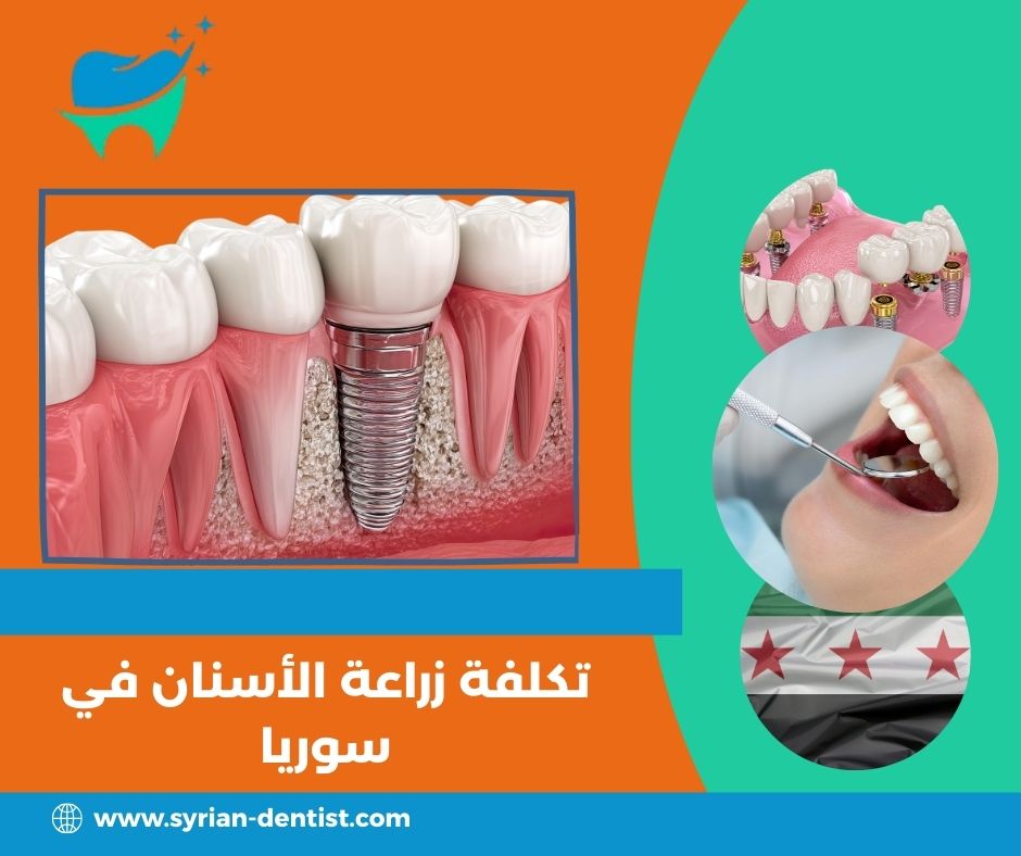 هل زراعة الأسنان مؤلمة؟