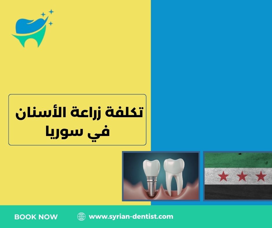 تكلفة زراعة الأسنان في سوريا