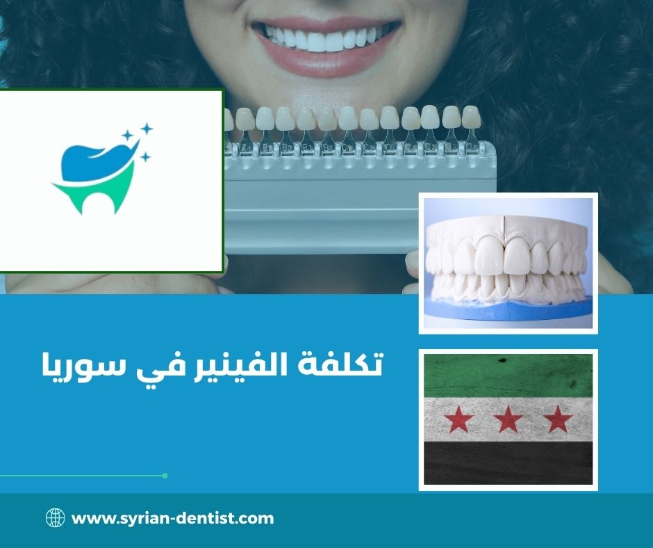 تكلفة الفينير في سوريا