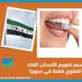 سعر تقويم الأسنان الفك العلوي فقط في سوريا