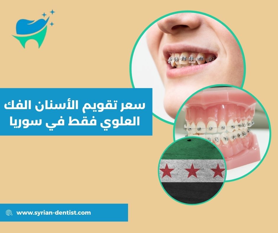 العوامل التي تؤثر على سعر تقويم الأسنان الفك العلوي فقط في سوريا