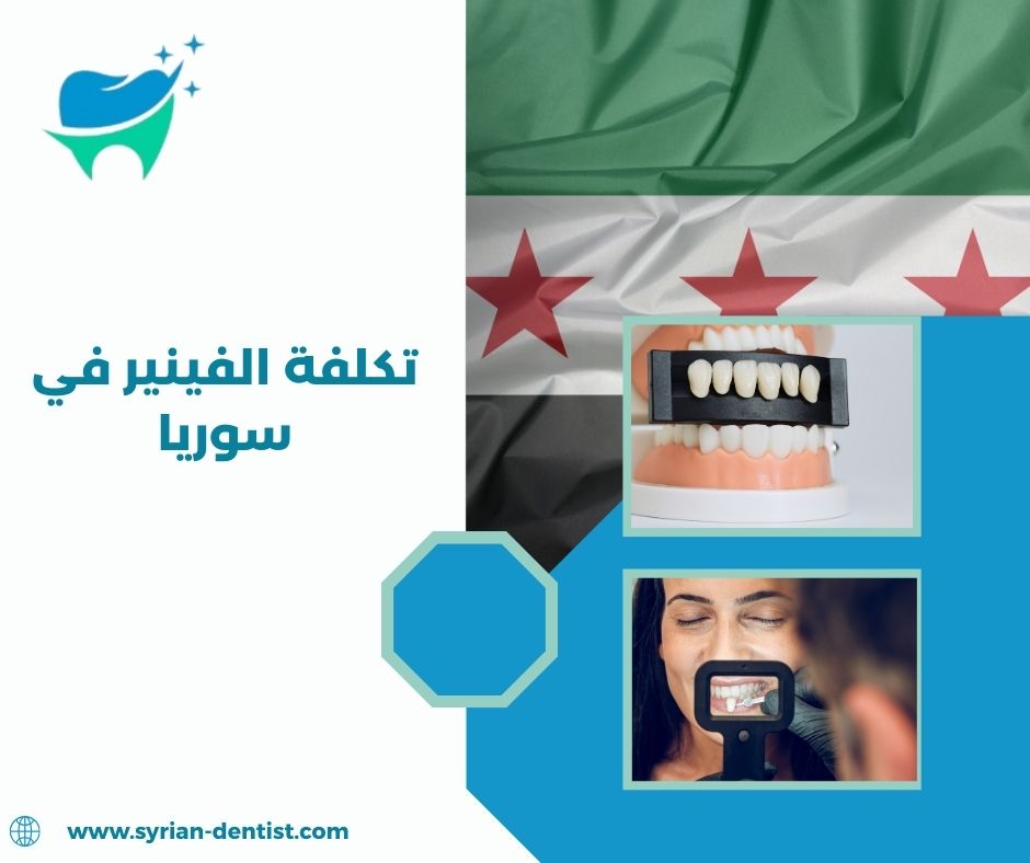 كيفية العناية بالفينير بعد التركيب