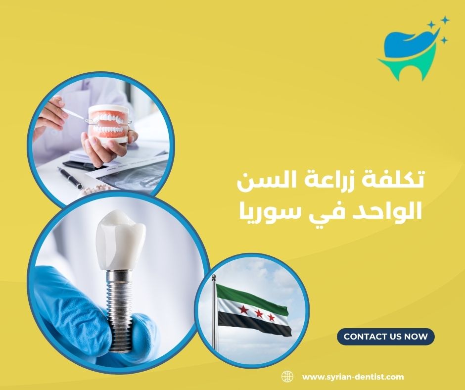 كم تستغرق عملية زراعة الأسنان؟