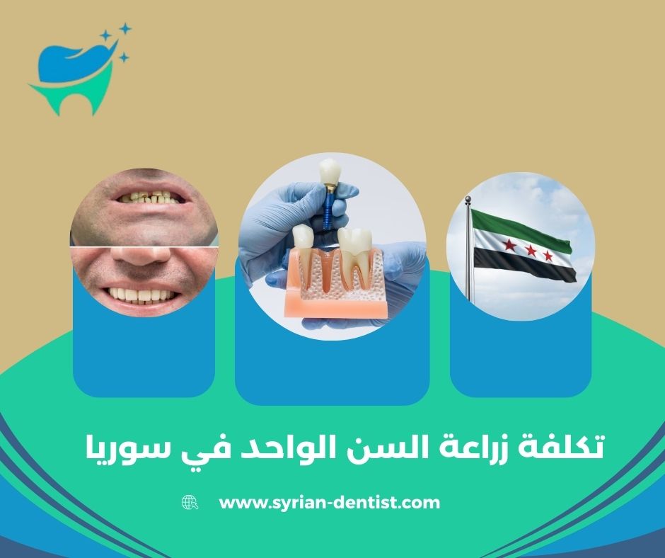 أنواع زرعات الأسنان المستخدمة في سوريا