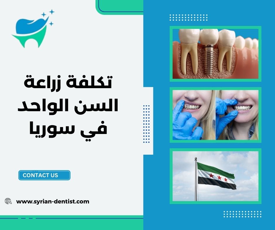 تكلفة زراعة السن الواحد في سوريا