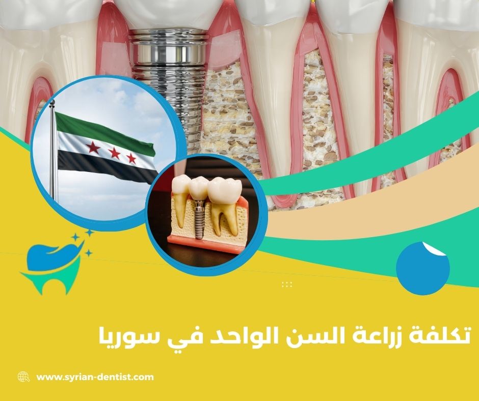 تكلفة زراعة السن الواحد في سوريا