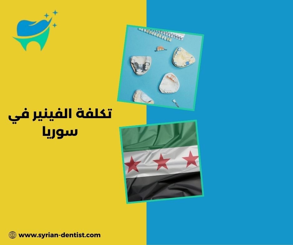 كيف يتم تركيب الفينير خطوة بخطوة؟