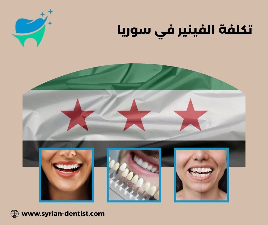 تكلفة الفينير في سوريا