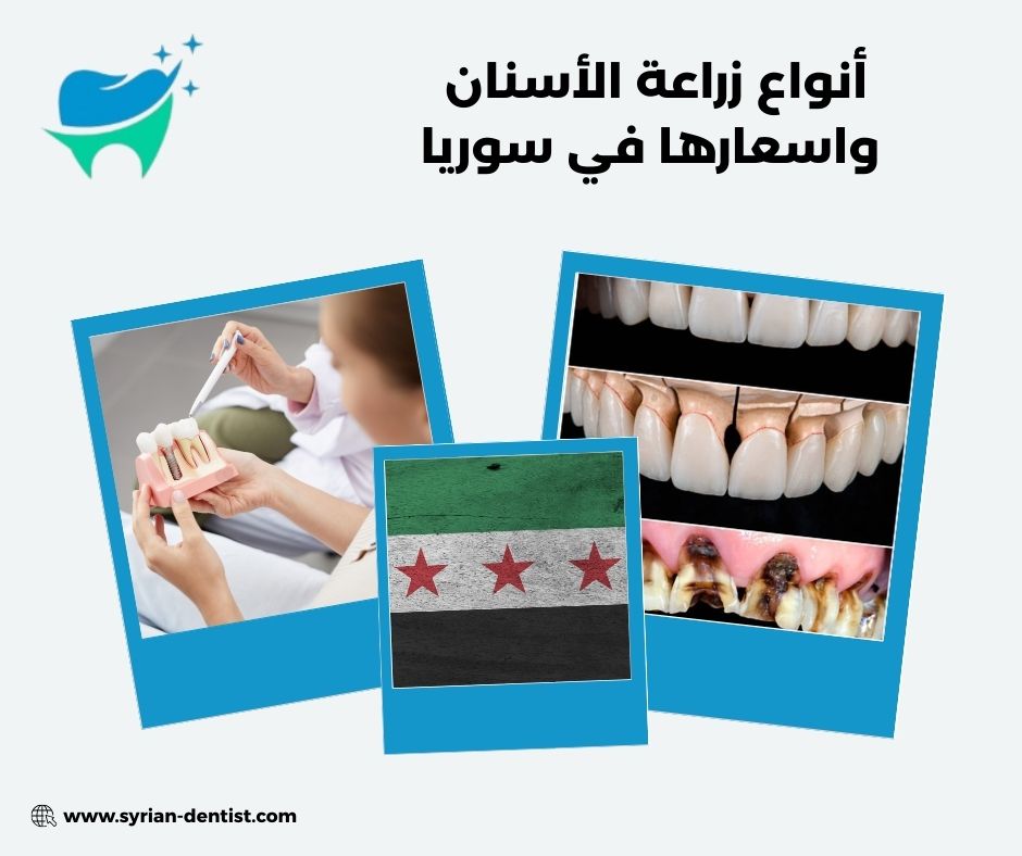 مراحل عملية زراعة الأسنان