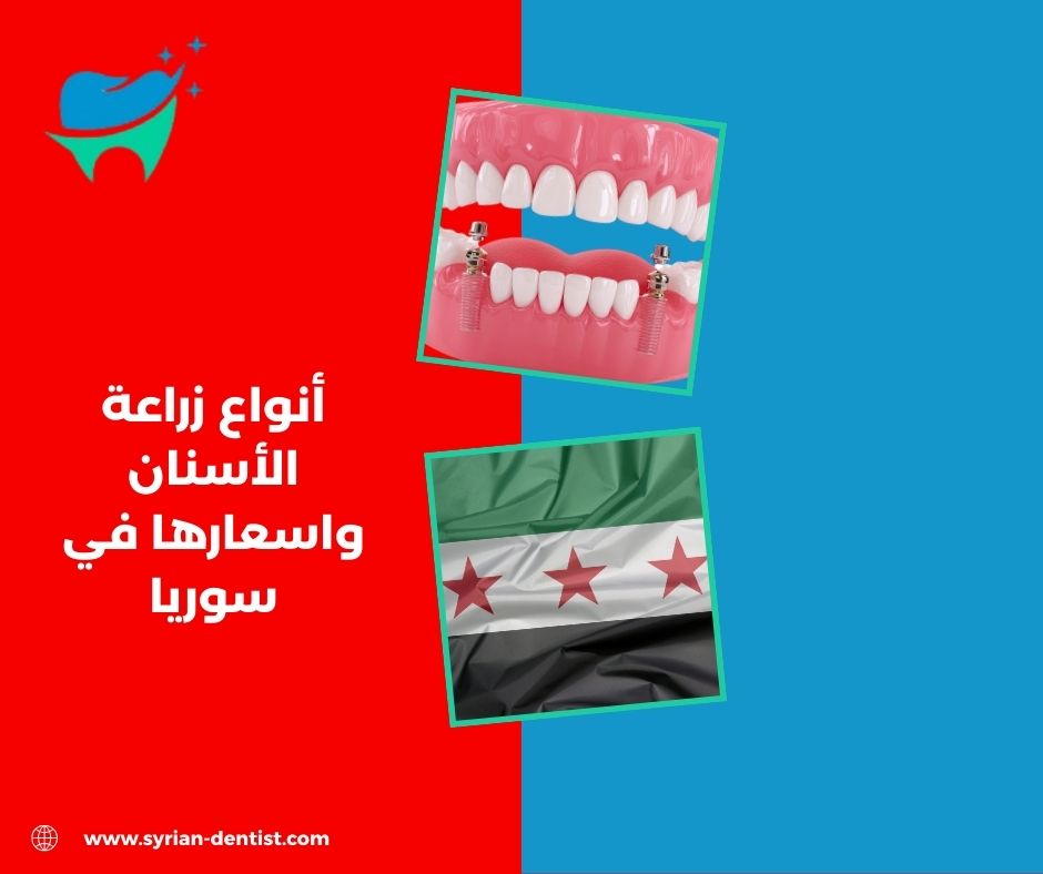 لماذا يلجأ المرضى إلى زراعة الأسنان؟