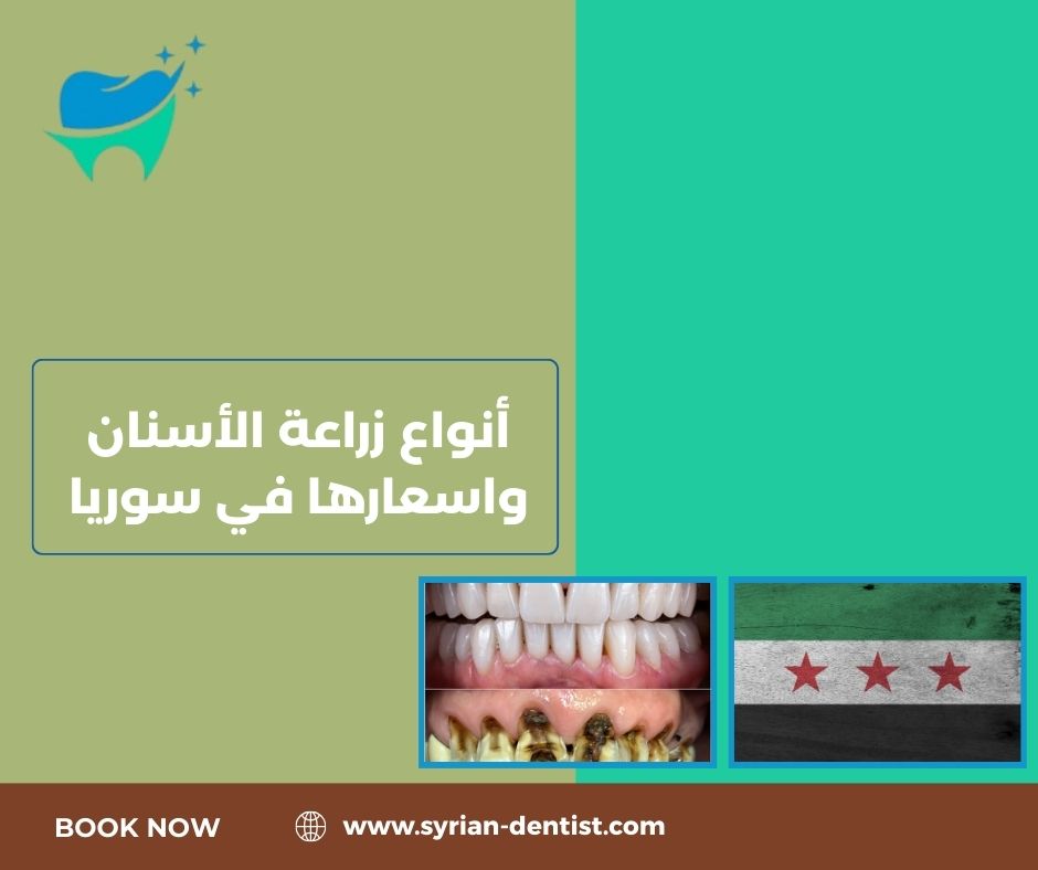 أنواع زراعة الأسنان واسعارها في سوريا